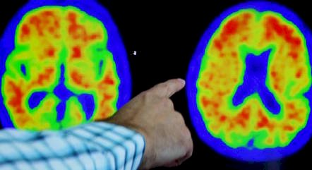 Vacina em testes tem potencial para revolucionar o curso da doença de Alzheimer